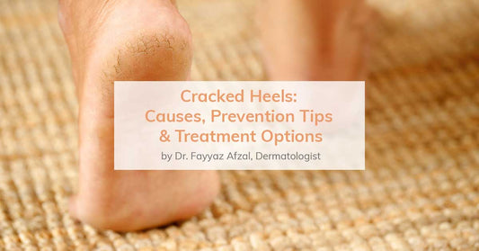 cracked-heels-causes-prevention-treatment